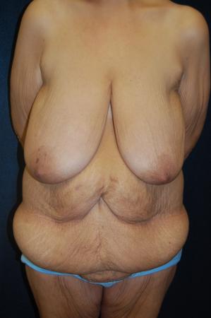 Post Bariatric Reconstruction: Patient 8 - Before 