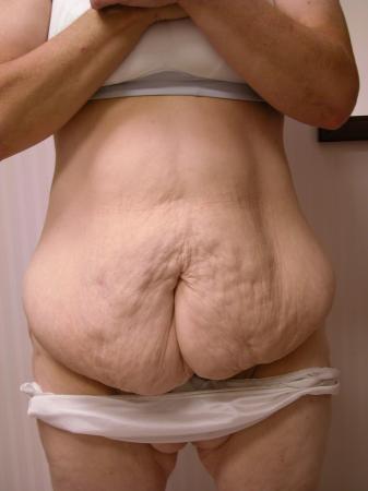 Post Bariatric Reconstruction: Patient 4 - Before 1