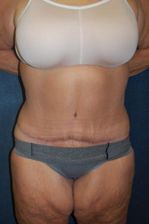 Post Bariatric Reconstruction: Patient 9 - After  