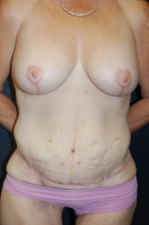 Post Bariatric Reconstruction: Patient 7 - After  