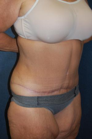 Post Bariatric Reconstruction: Patient 9 - After 2