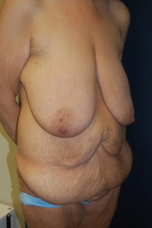 Post Bariatric Reconstruction: Patient 8 - Before and After 2