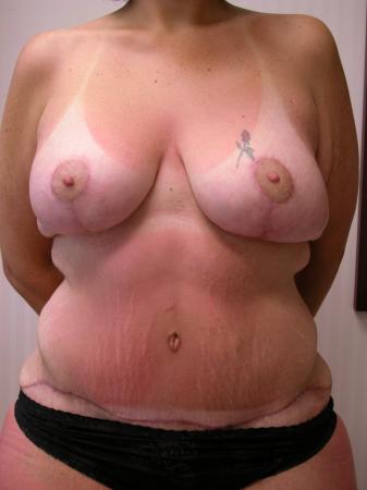 Post Bariatric Reconstruction: Patient 2 - After  