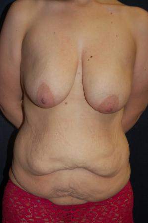 Post Bariatric Reconstruction: Patient 10 - Before 