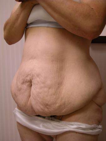 Post Bariatric Reconstruction: Patient 4 - Before 2