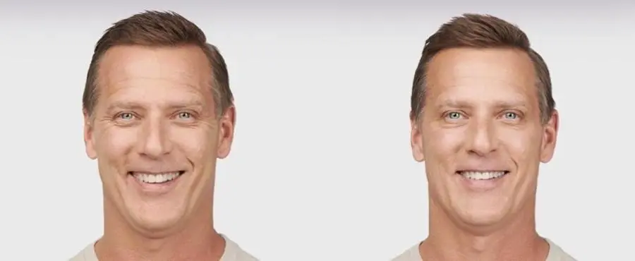 BOTOX® Cosmetic: Patient 7 - Before and After 1