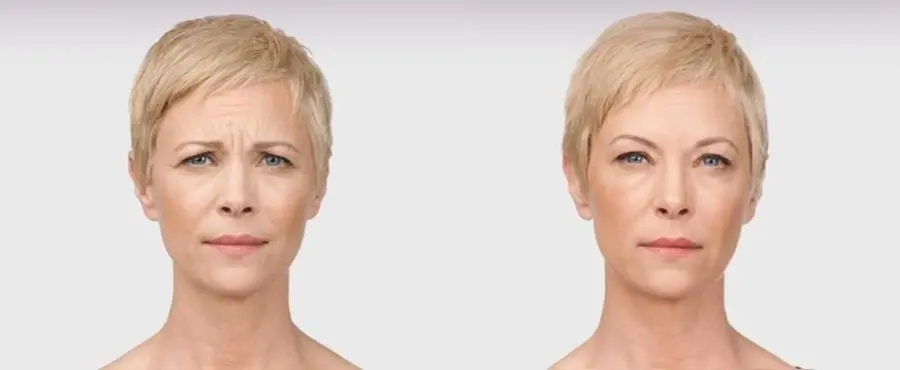 BOTOX® Cosmetic: Patient 8 - Before and After  