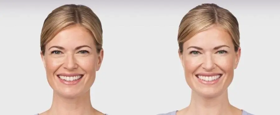 BOTOX® Cosmetic: Patient 6 - Before and After 1