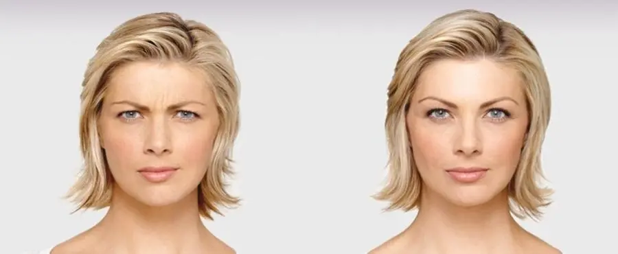 BOTOX® Cosmetic: Patient 1 - Before and After 1