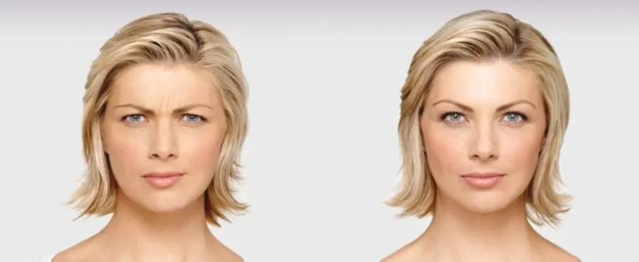 BOTOX® Cosmetic: Patient 5 - Before and After 1