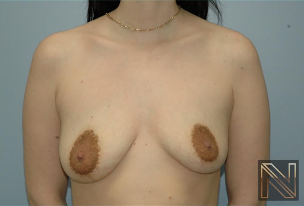 Breast Augmentation: Patient 19 - Before 1