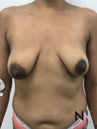 Breast Lift: Patient 1 - Before Image 1
