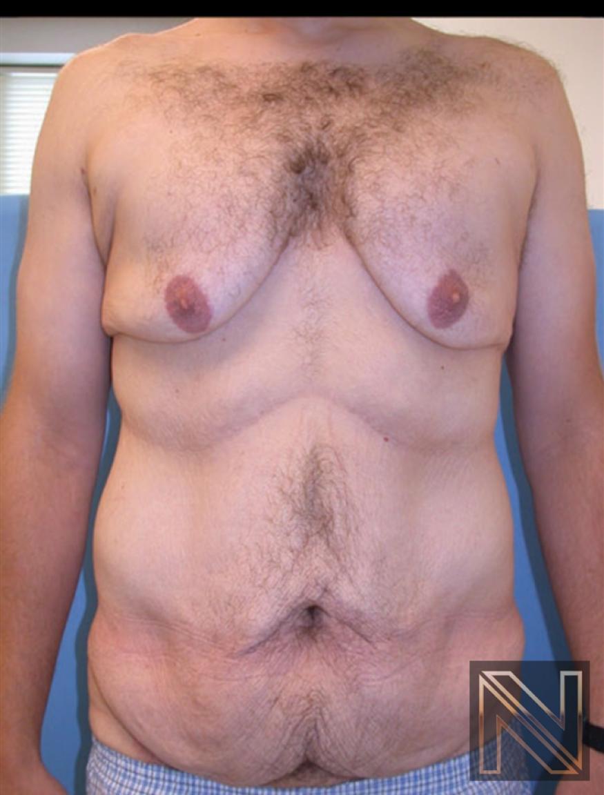 Gynecomastia: Patient 9 - Before 