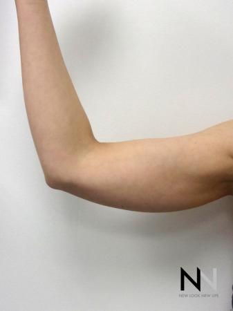 Liposuction: Patient 26 - Before Image 1