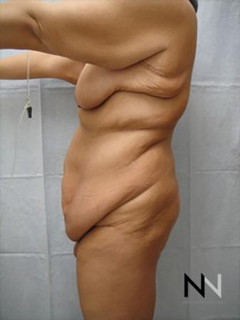 Abdominoplasty: Patient 17 - Before 2