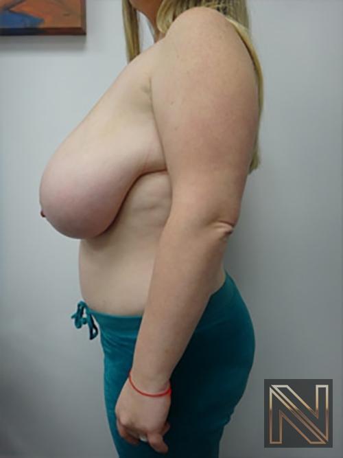 Breast Reduction: Patient 9 - Before 4