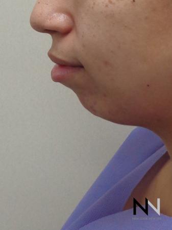 Chin Augmentation: Patient 1 - Before and After Image 2