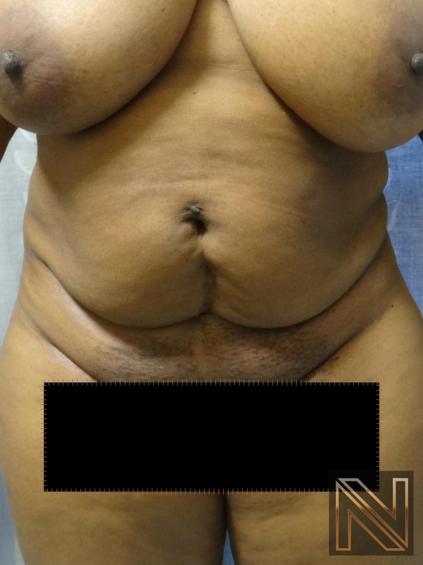 Mini Tummy Tuck: Patient 1 - Before 1