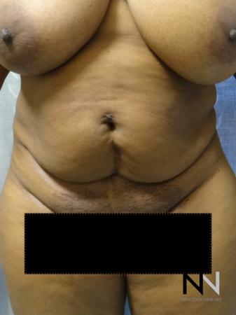 Mini Tummy Tuck: Patient 1 - Before Image 1