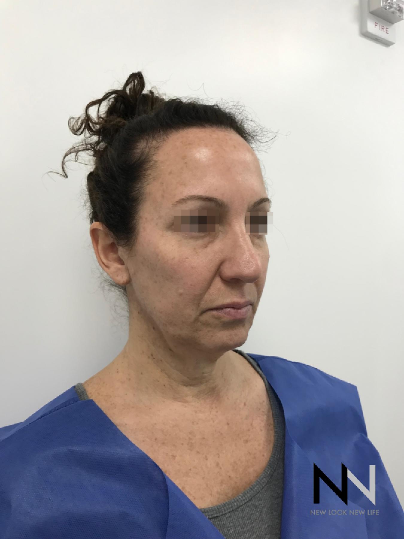 Facelift/Mini Facelift: Patient 3 - Before 