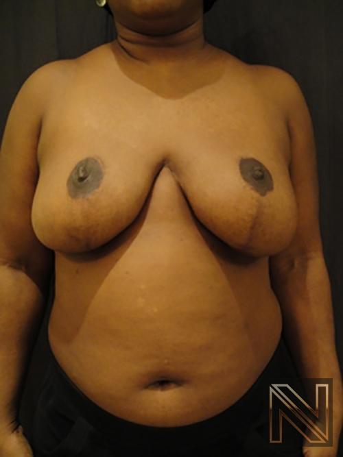 Breast Reduction: Patient 3 - After 1