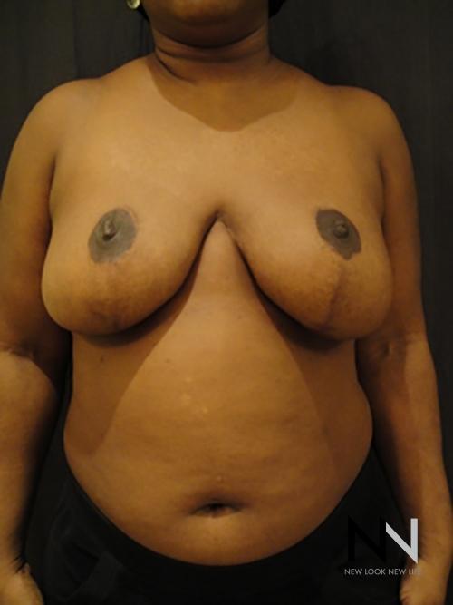 Breast Reduction: Patient 3 - After  