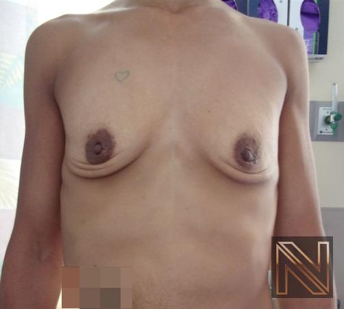 Breast Augmentation: Patient 18 - Before 1