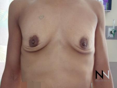 Breast Augmentation: Patient 18 - Before Image 1