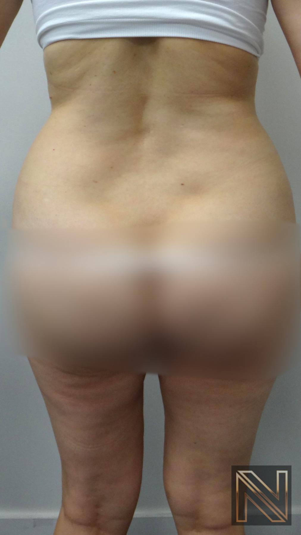 Liposuction: Patient 12 - Before and After 2