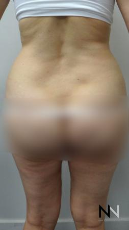 Liposuction: Patient 12 - Before and After Image 2
