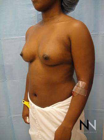 Breast Augmentation: Patient 12 - Before Image 2