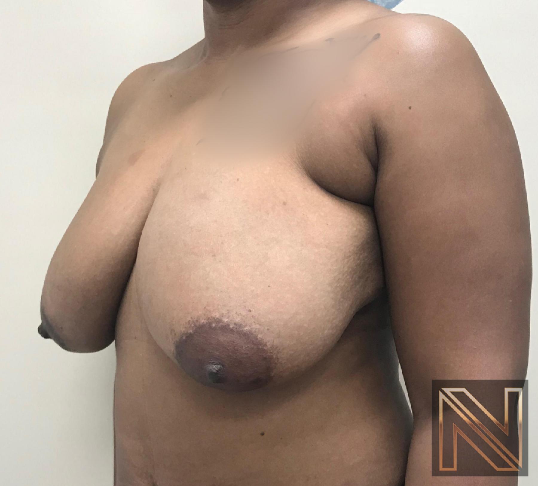 Breast Lift: Patient 14 - Before and After 3