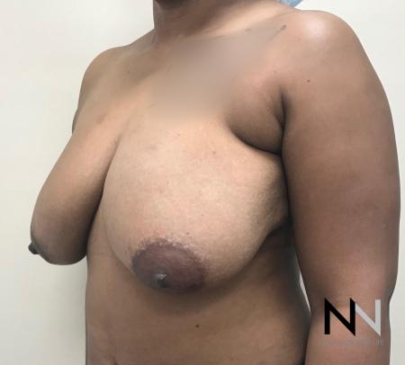 Breast Lift: Patient 14 - Before and After Image 3