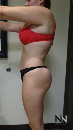 Butt Augmentation: Patient 3 - After Image 4