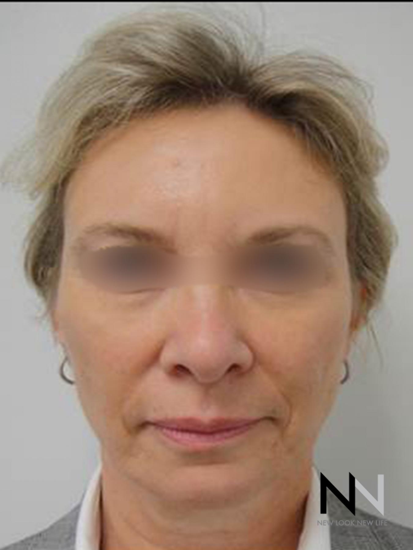 Liquid Facelift: Patient 6 - After  