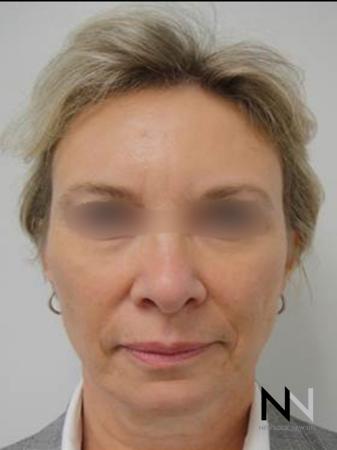 Liquid Facelift: Patient 6 - After Image 1