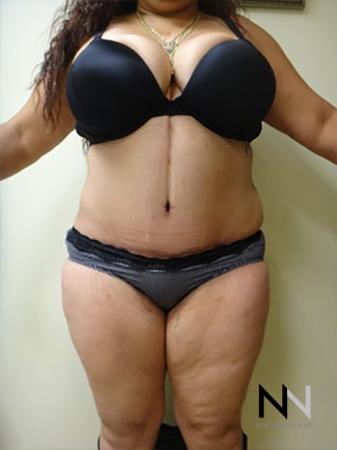 Abdominoplasty: Patient 11 - After Image 1