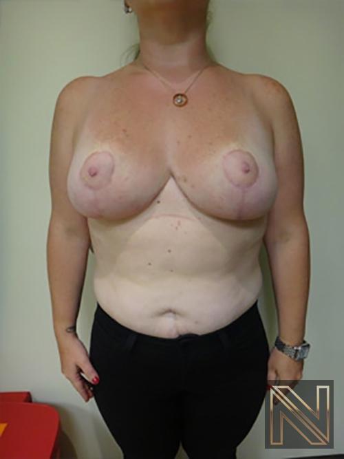 Breast Reduction: Patient 9 - After 1
