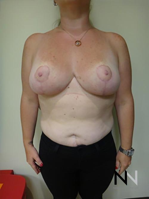 Breast Reduction: Patient 9 - After  