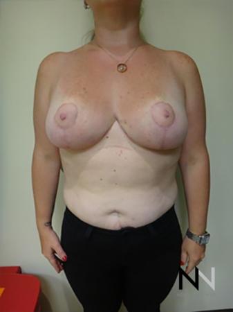 Breast Reduction: Patient 9 - After Image 1