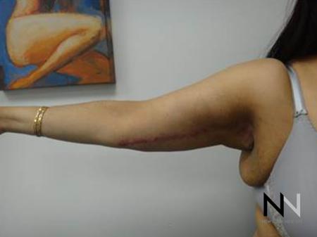 Brachioplasty: Patient 3 - After Image 2