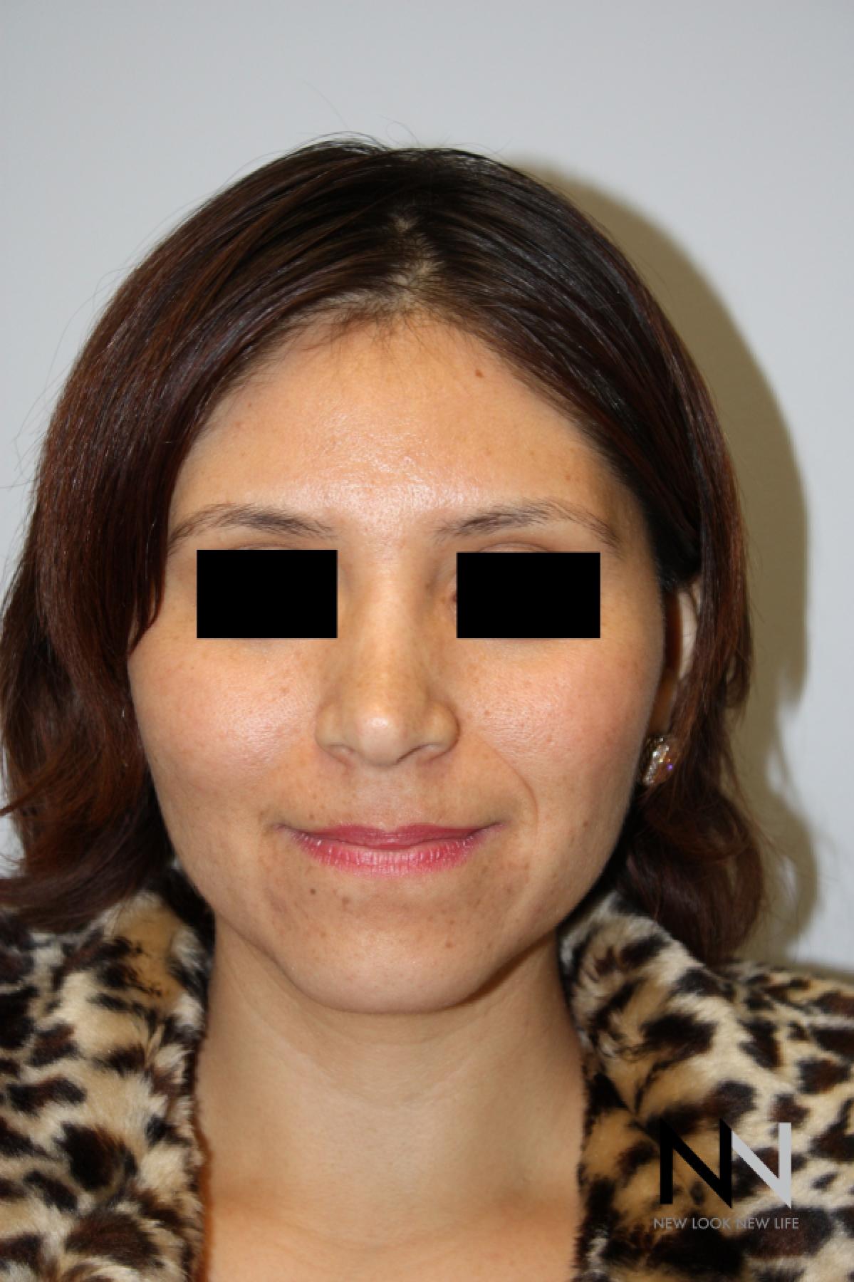 Rhinoplasty: Patient 5 - After  