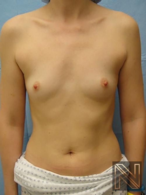 Breast Augmentation: Patient 5 - Before 