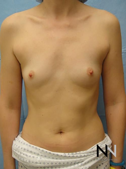 Breast Augmentation: Patient 5 - Before 