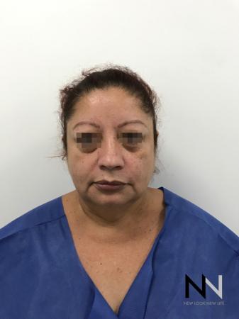 Facelift/Mini Facelift: Patient 2 - Before and After Image 5