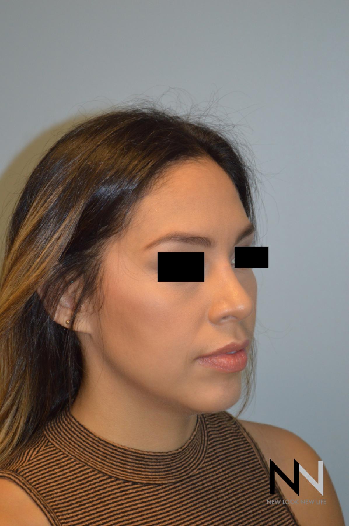 Rhinoplasty: Patient 6 - After 5