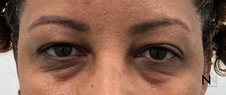 Blepharoplasty: Patient 1 - Before Image 1