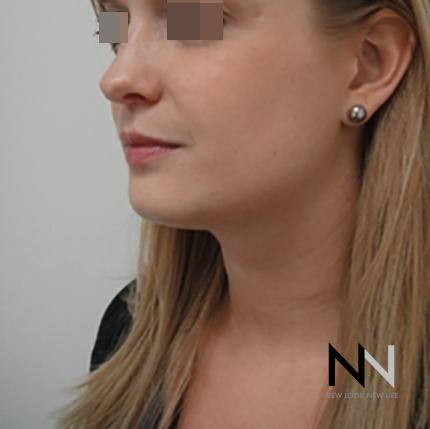 Liposuction: Patient 1 - After Image 2