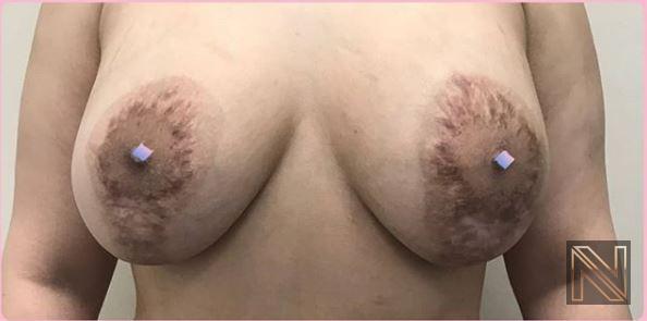 Breast Lift: Patient 9 - Before 1