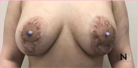 Breast Lift: Patient 9 - Before Image 1